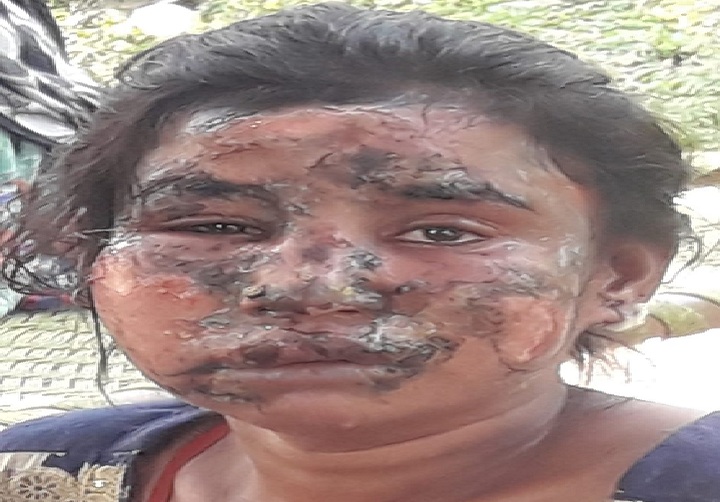मुजफ्फरनगरः पुरकाजी थाना के गाव फलौदा में युवक ने पत्नी पर डाला तेजाब