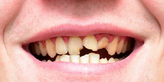 ज्यादा मीठी चीजें खाने से खराब हो जाते हैं दांत